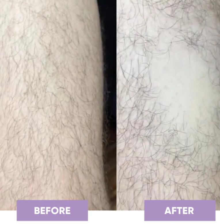 Ultimate Hair Removal Revolution